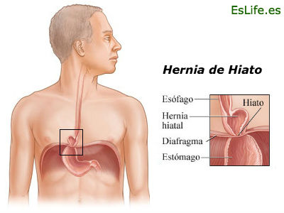 Hernia de hiato infografia