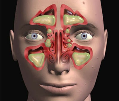 Tipos de sinusitis