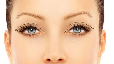 Blefaroplastia