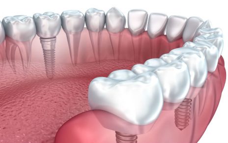Implantes dentales tipos y precios