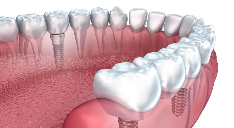 Implantes dentales tipos y precios