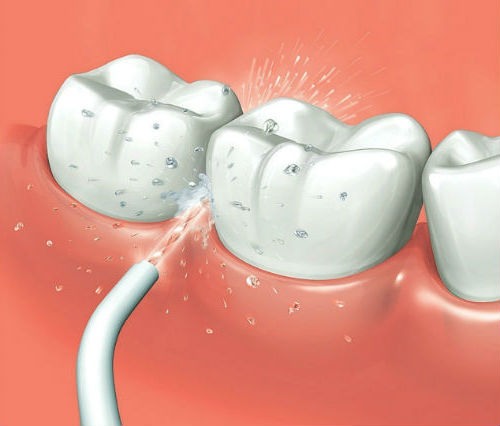 irrigador dental