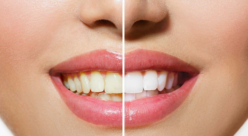 Preguntas frecuentes blanqueamiento dental