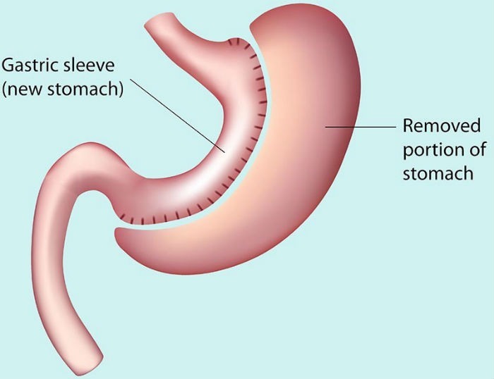 Sleeve gastrico