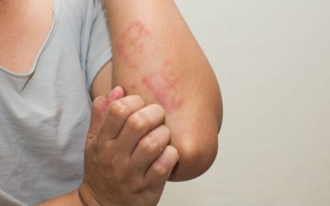 tratar dermatitis atopica