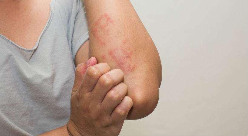 tratar dermatitis atopica