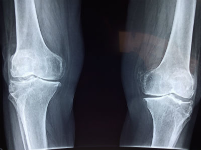 Lesión de rodilla complicada