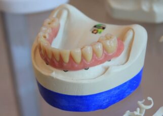 Implantes Dentales 2022