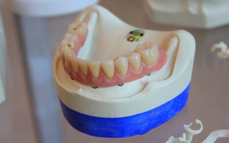 Implantes Dentales 2022