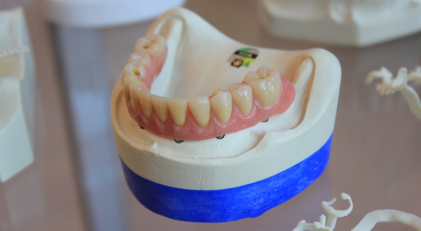 Implantes Dentales 2022