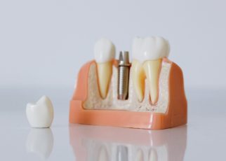 Implantología dental