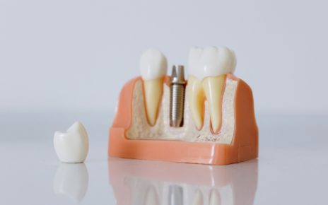 Implantología dental