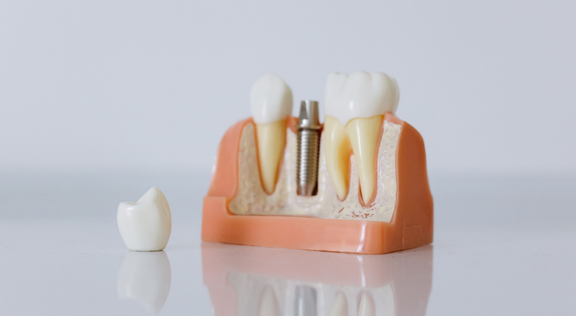 Implantología dental